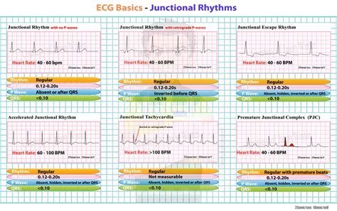Junctional Rhythms | Heart blocks, Nursing mnemonics, Ekg interpretation