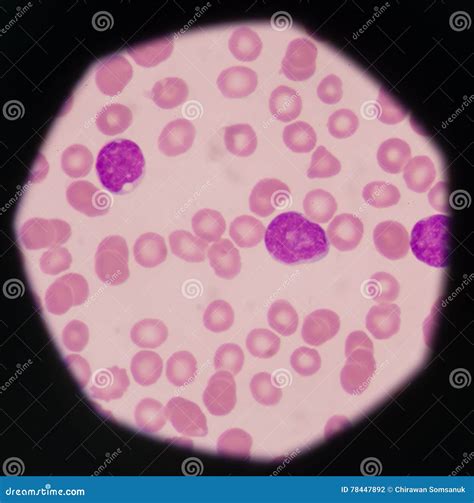 Blast Cells in Peripheral Blood Images. Stock Photo - Image of disease, plasma: 78447892