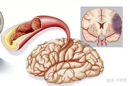 得了脑梗怎么治疗？ - 知乎