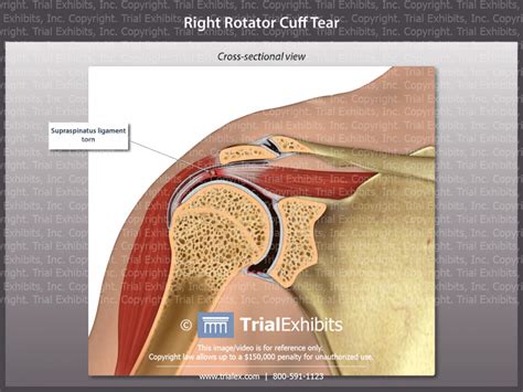 Right Rotator Cuff Tear - TrialExhibits Inc.