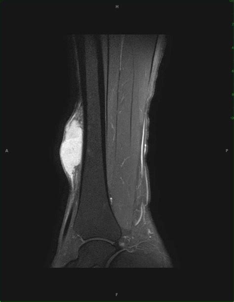 Spindle Cell Sarcoma, Leg - Musculoskeletal Radiology Case Studies - CTisus CT Scanning