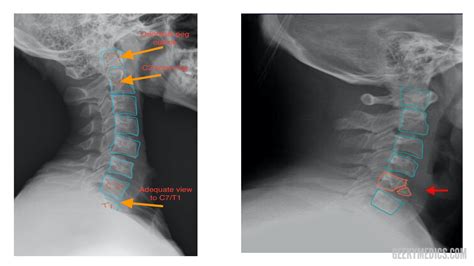 What Does A Normal Cervical Spine X Ray Look Like In Taiwan - Infoupdate.org