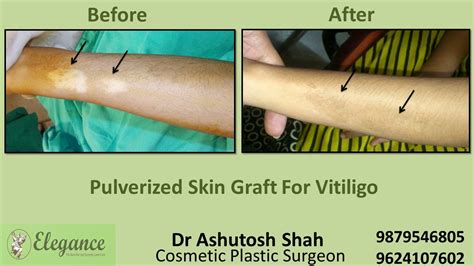 Hand Vitiligo Treatment in Valsad, Gujarat