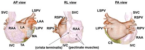 Atrial Fibrillation and Underlying Structural and Electrophysiological ...