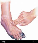 Peripheral vascular disease hi-res stock photography and images - Alamy