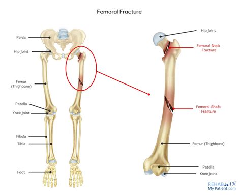 Femoral Fracture | Rehab My Patient