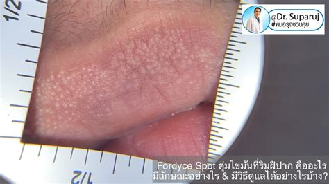 Fordyce Spot ตุ่มไขมันที่ริมฝีปาก คืออะไร มีลักษณะอย่างไร & มีวิธีดูแลได้อย่างไรบ้าง?