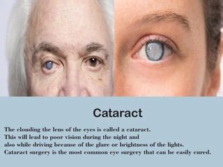 Image result for Types of Vision Problems