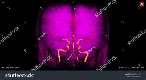 Image result for Maximum Intensity Projection Python