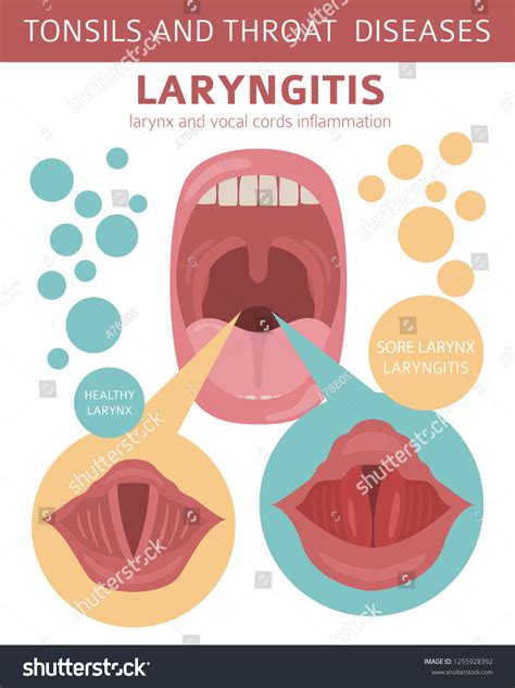 Vektor Stok Tonsils Throat Diseases Laryngitis Symptoms Treatment (Tanpa Royalti) 1255928392