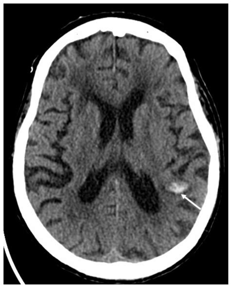 Neuroimaging of the Most Common Meningitis and Encephalitis of Adults: A Narrative Review