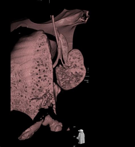 Unilateral right pulmonary hypoplasia with right azygous lobe ...