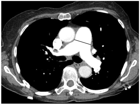 The Significance of Pulmonary Artery Size in Pulmonary Hypertension