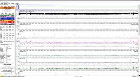 Image result for CPAP Report Example