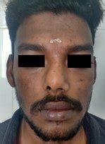 Rhinoplasty | Nose job - AMICUS CLINIC