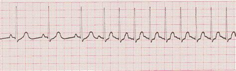 Image result for Telemetry Practice