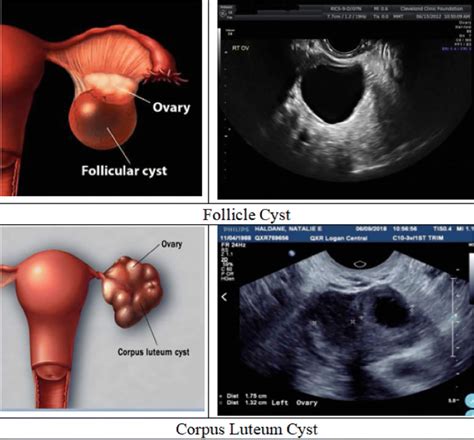 Ultrasound On Ovarian Cyst