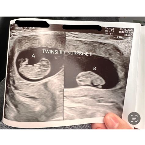 9 Weeks Pregnant Ultrasound Twins