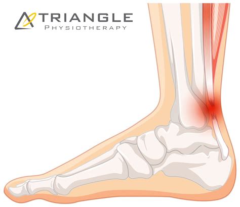 Achilles Tendonitis Treatment | Triangle Physiotherapy