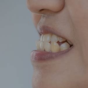 Smart Aligners