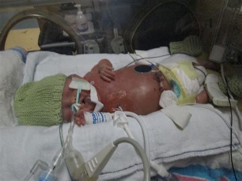 JAM sessions: Lessons learned through a micro-preemie: Week 8 (31 weeks ...