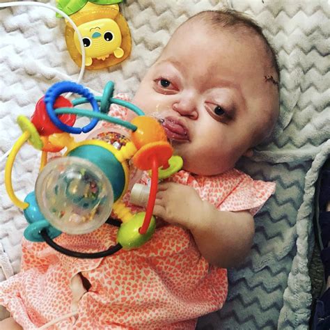 Pfeiffer syndrome: what is it, causes, symptoms, treatment, prognosis