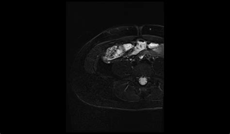 Image result for Normal Appendix MRI