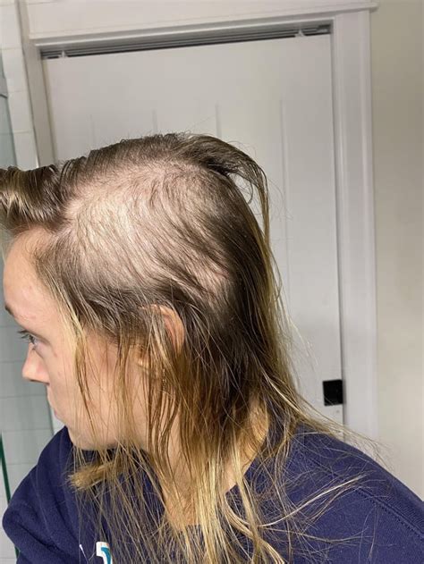 Image result for Diffuse Alopecia