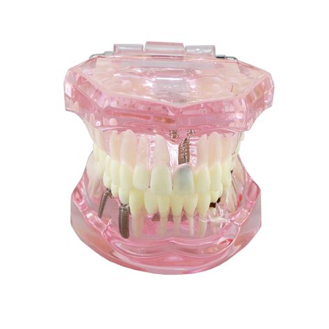 Dental Implant Teeth Model Bridge Restoration | Ubuy India
