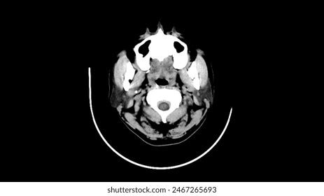 Image result for Normal Brain CT Scan