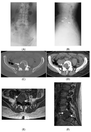 Imaging Features of Intraosseous Schwannoma: A Case Series and Review ...