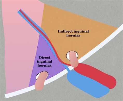 Inguinal Hernia – SURGERY STUDENT