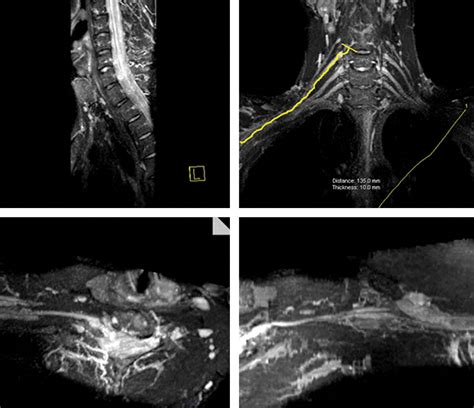 MR Neurography: Past, Present, and Future | AJR