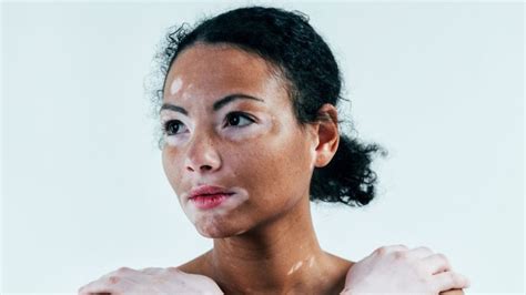 Vitiligo | பால் தொடர்பான பொருட்களால் வெண்புள்ளி ஏற்படும் - விட்டிலிகோ ...