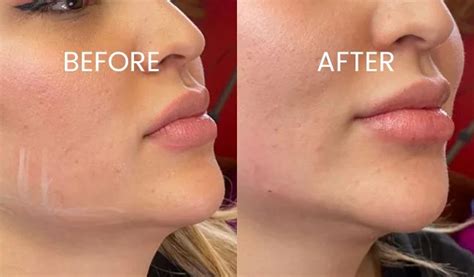 New Thread Lift 的图像结果