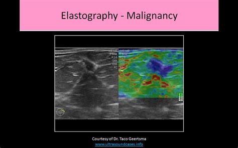 Breast Ultrasound Registry Review Course