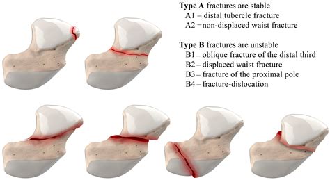Imaging Diagnosis and Management of Carpal Trauma and Instability—An ...