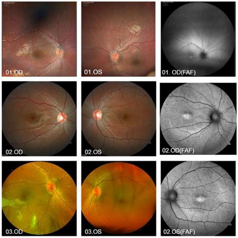 GUCY2D-Associated Retinopathy: A Comparative Study Between Humans and ...