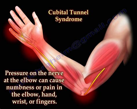 Cubital Tunnel Syndrome Ulnar Nerve Entrapment - Everything You Need To ...