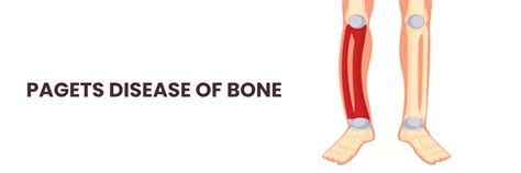 Pagets Bone Disease :Causes,Risk Factors and Treatments