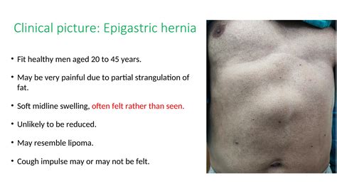 VENTRAL HERNIA - Abdominal Wall Reconstruction AWR - Surgery -Repair ...