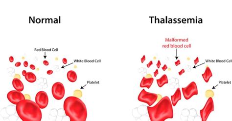 Image result for Haemoglobin Disorders