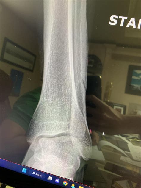 Fibula Stress Fracture : r/brokenbones