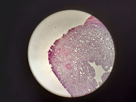 Fig. 5: Photomicrograph of endometrial polyp. (HandE, 4x)