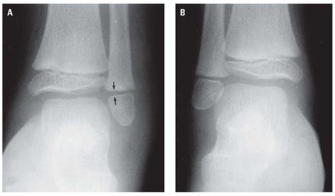 Ankle | Radiology Key
