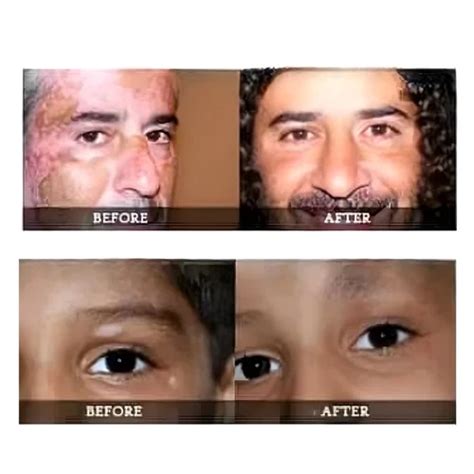 Vitiligo Organics for White Spots Skin Repair India | Ubuy