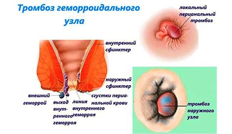 Пентоксифиллин: инструкция по применению, цена, отзывы, аналоги и для ...