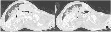 Versatility of Intermittent Abdominal Pressure Ventilation in a Case of ...