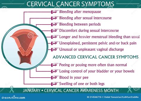 Stage 1 Cervical Cancer Symptoms