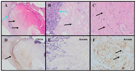 Local Injection of Submicron Particle Docetaxel is Associated with ...